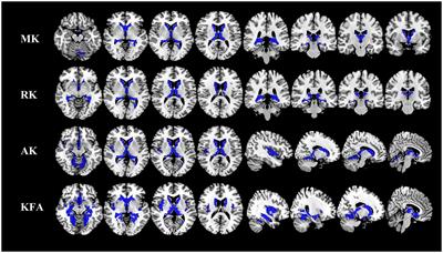 Diffusion and functional MRI reveal microstructural and network connectivity impairment in adult-onset neuronal intranuclear inclusion disease